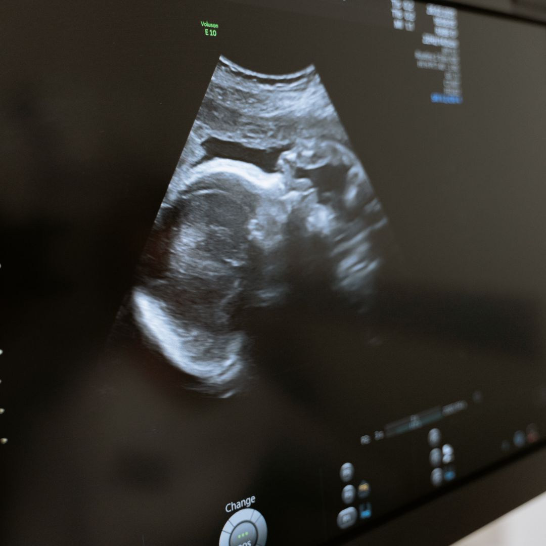 CIR en el embarazo: Qué significa que el bebé es pequeño para su edad gestacional CIR en el embarazo, ecografía