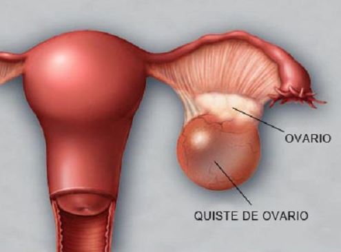 Quiste de ovario - Síntomas y tratamientos